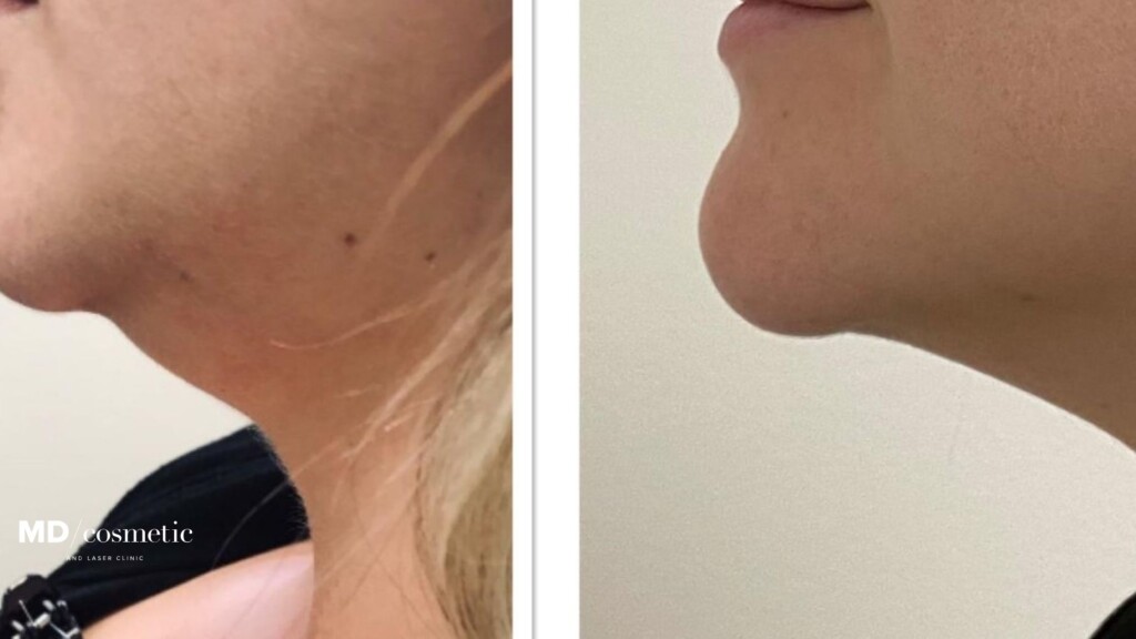 belkyra abbotsford before and after chin