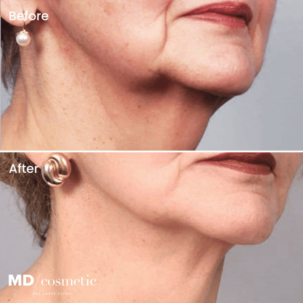 morpheus8 treatment before and after