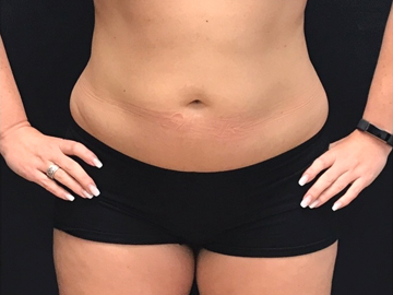 Coolsculpting