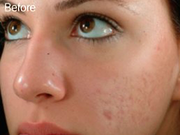 Microneedling
