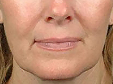 Platelet-Rich Plasma