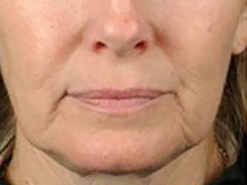 Platelet-Rich Plasma