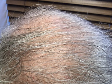 Platelet-Rich Plasma