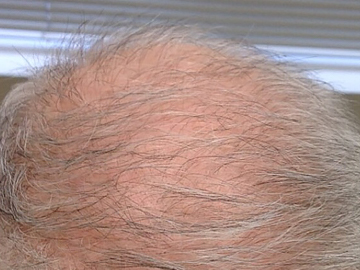 Platelet-Rich Plasma